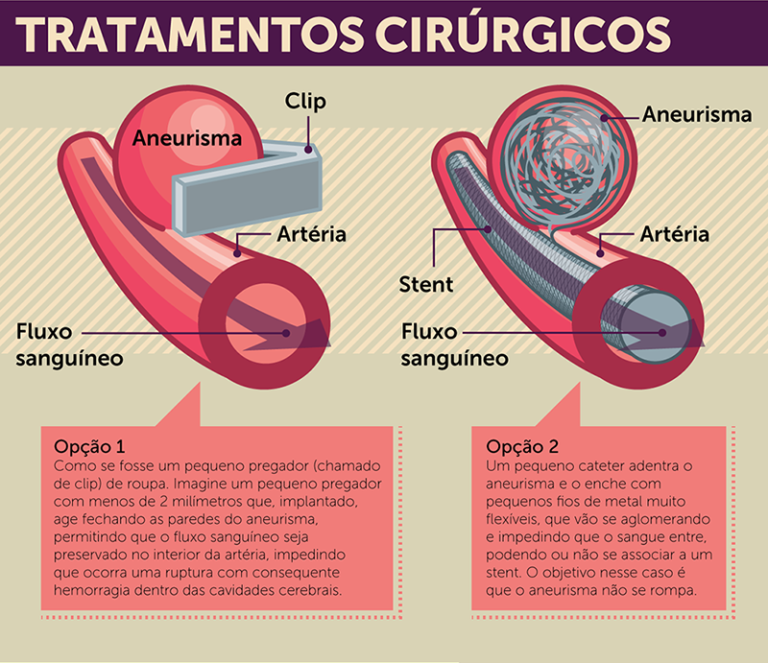 O Que Aneurisma Cerebral E Como Tratar Neurocirurgia E Tratamento