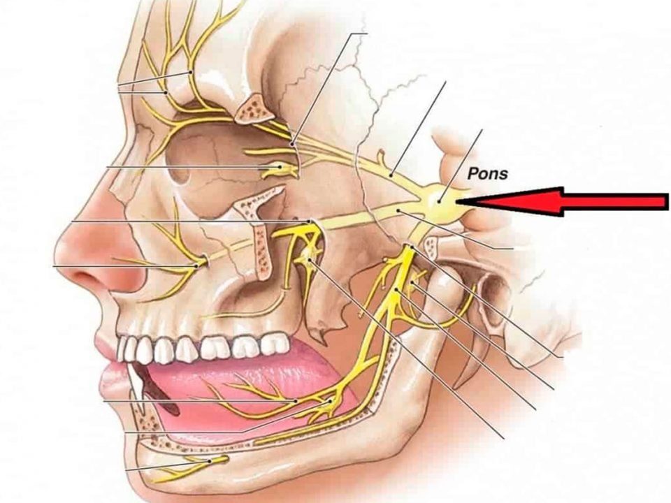 Neuralgia do trigemeo compressao por balao