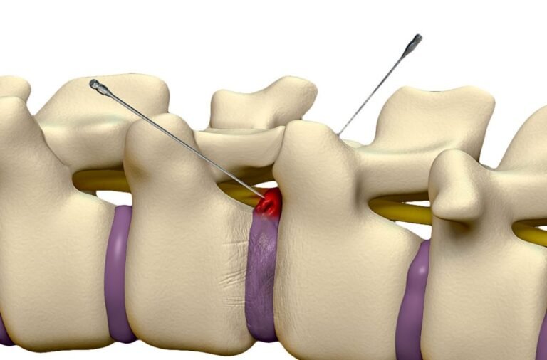 Infiltração na coluna: o que é e quando fazer? | Neurocirurgia | Dr ...