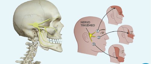 Desenho esquelético indicando onde fica a dor da neuralgia do trigêmeo