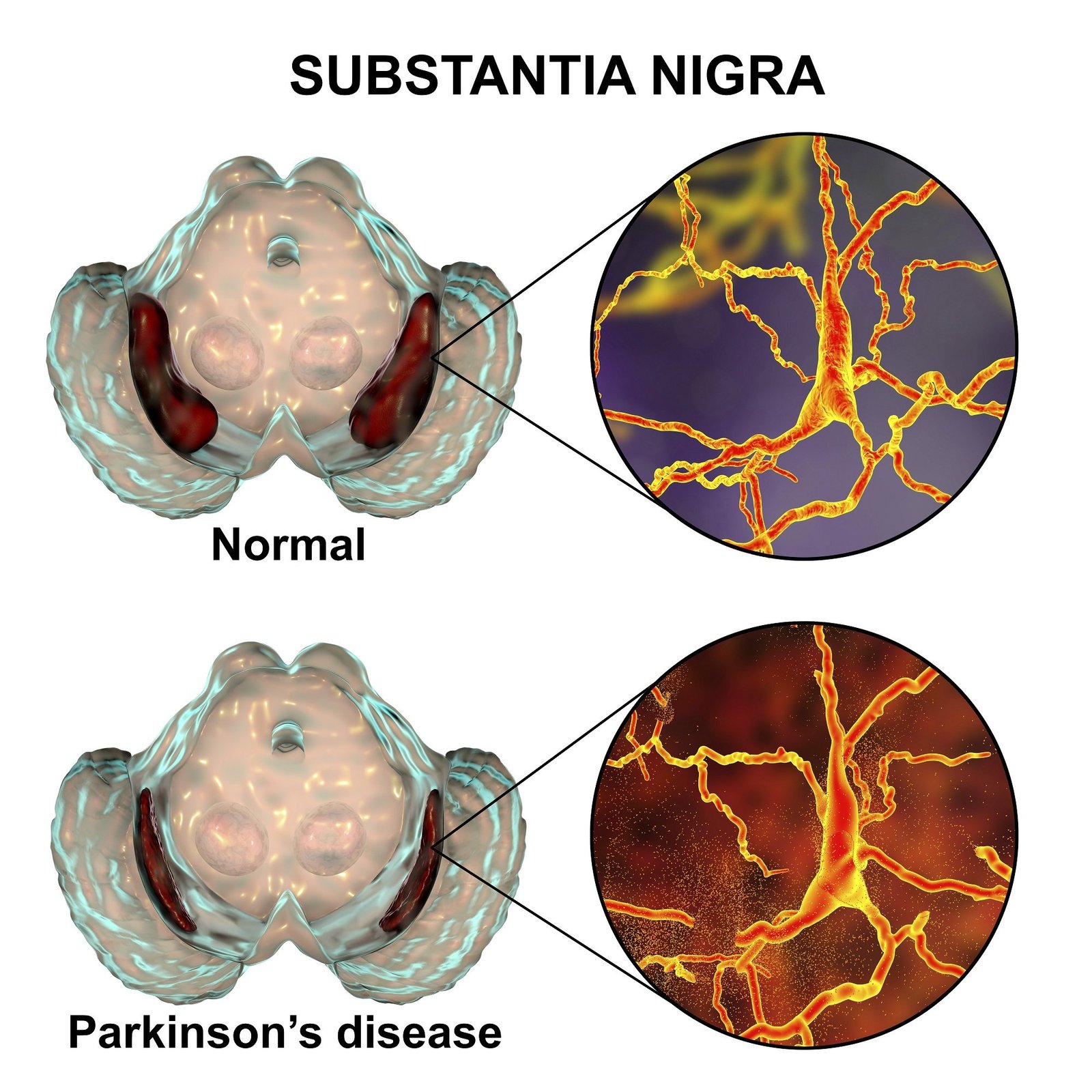 Conheça Os 16 Sintomas Da Doença De Parkinson Neurocirurgia E Tratamento Para Dor Em Sp