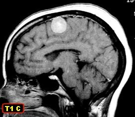 Imagem de tomografia, para descobrir se há meningioma.