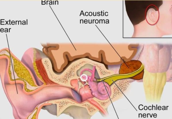 Imagem de simulação gráfica do Neurinomas do Acústico.