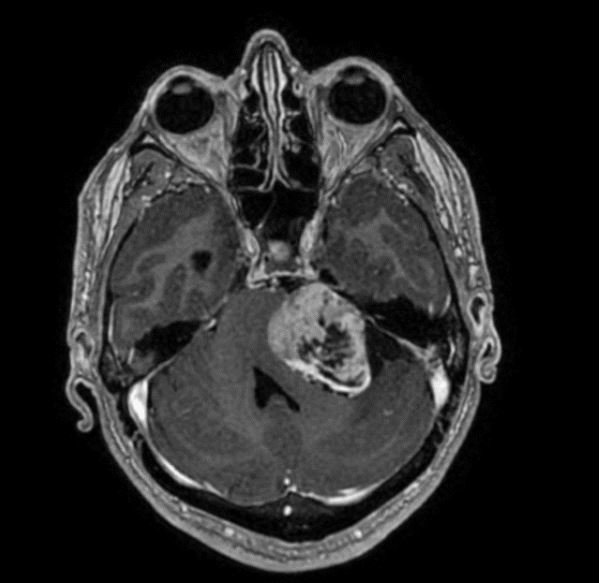  Imagem da ressonância magnética de um paciente com um volumoso Neurinoma do Acústico à esquerda. Reparem que o quarto ventrículo encontra-se comprimido e, desta forma, ocorre hidrocefalia à montante (não visualizado nesta imagem