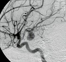 Exame de imagem de uma aneurisma cerebral.