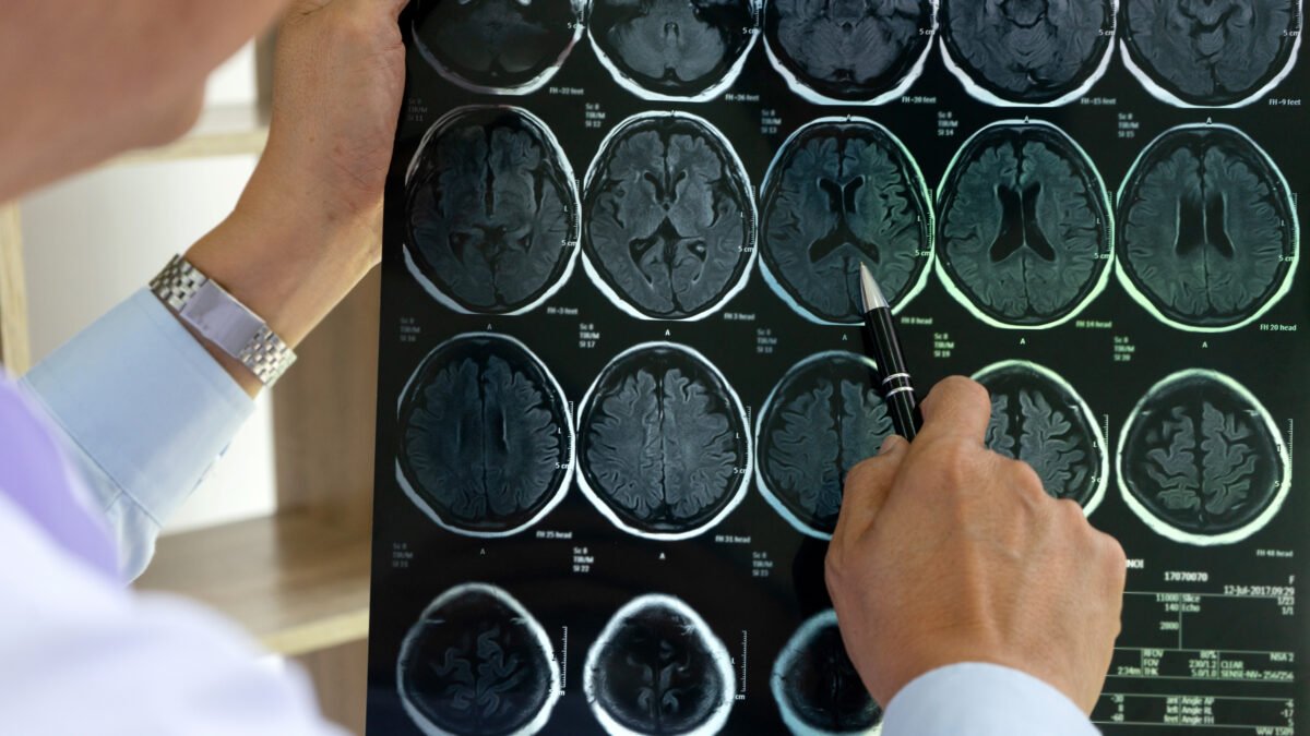 Fotografia de médico segurando o exame que detecta neuralgia do trigêmeo.