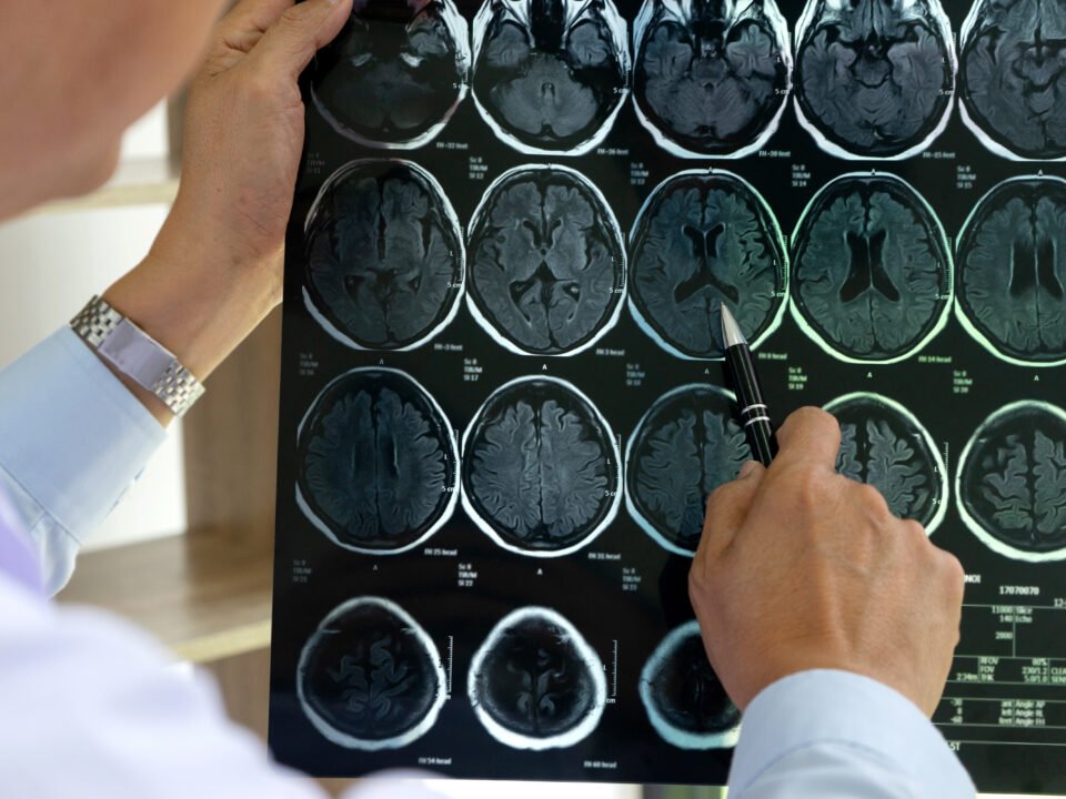 Fotografia de médico segurando o exame que detecta neuralgia do trigêmeo.
