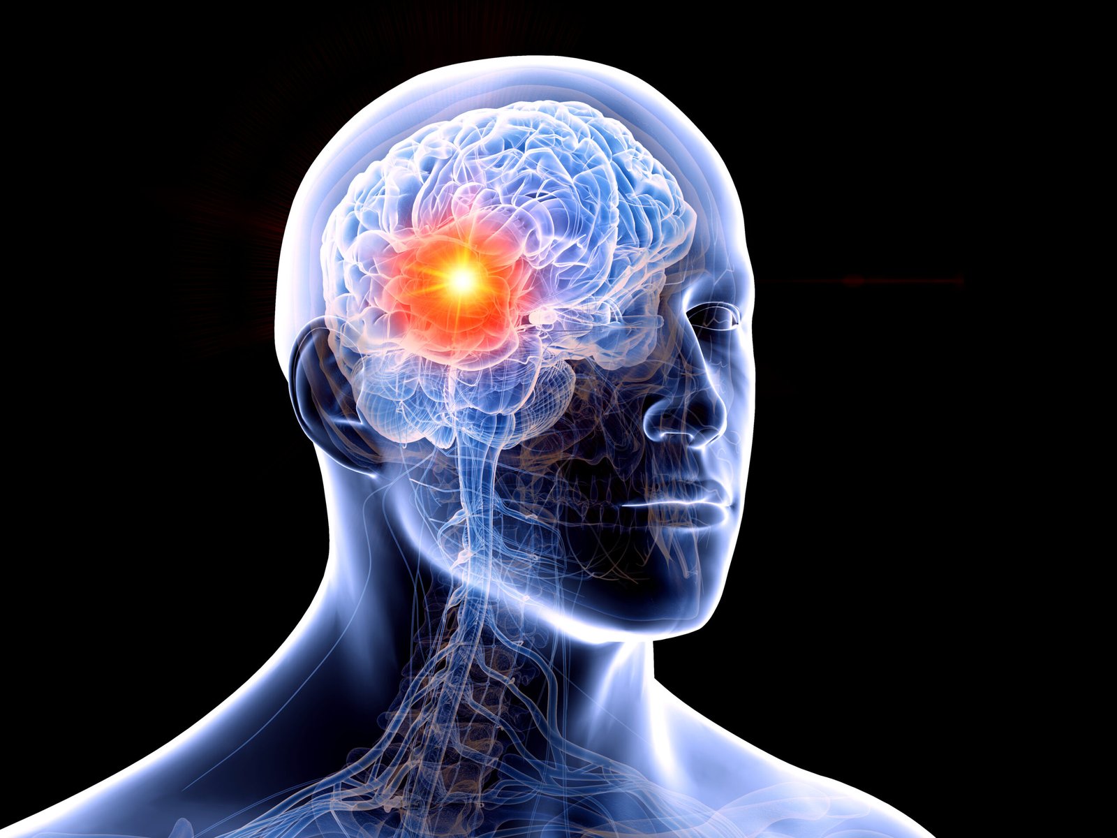 Imagem de criação computadorizada do crânio do ser humano. Mostra o cérebro com tumor do tipo glioblastoma grau 4.
