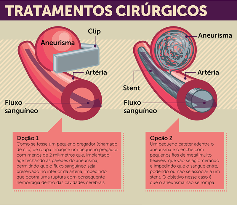 Imagens que demostram as duas possíveis formas de tratamento para aneurisma cerebral, são elas: Craniotomia e Endovascular