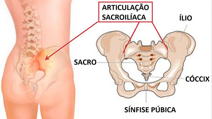 imagens demonstrativas de onde está localizado a articulação sacrilíacas, a fim de demonstrar onde ocorre a inflamação sacroileíte.