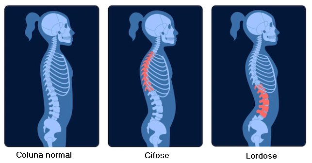  Imagem demonstrativa de três cenários, uma um esqueleto com coluna normal, uma com cifose e outra com lordose.