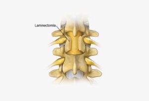  ilustração gráfica do procedimento laminectomia