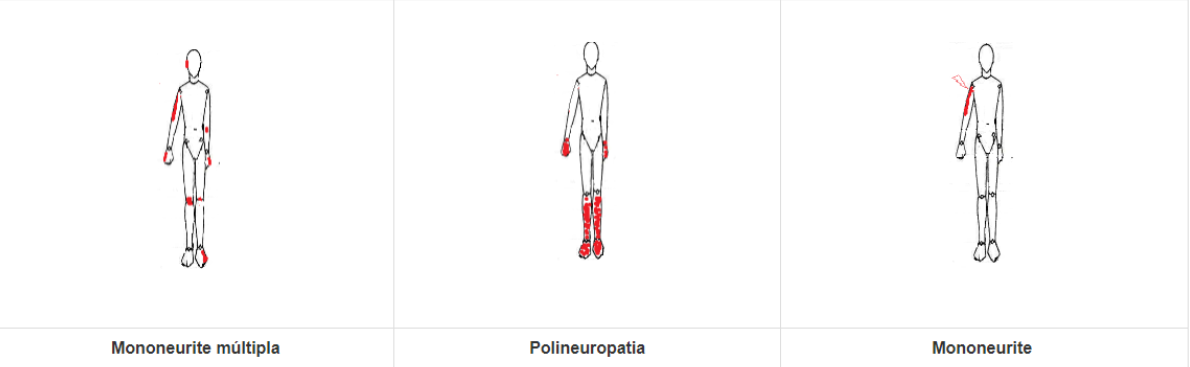 Desenhos de bonequinhos indicando as dores da mononeurite múltipla, polineuropatia e mononeurite.