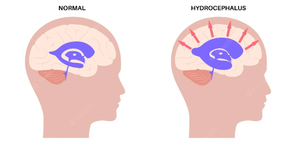  Imagem comparativa do cérebro de um paciente com e sem hidrocefalia.