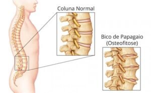 Bico de papagaio na coluna: sintomas e tratamento (osteofitose)