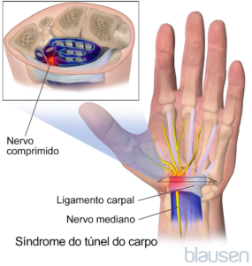 Fotografia da localização do síndrome do Túnel do Carpo.