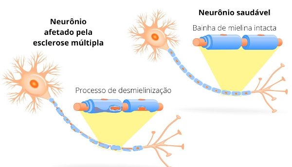  Ilustração de uma comparação da bainha de mielina saudável e não saudável, no caso, que sofreu ataque do sistema imunológico, causando a esclerose múltipla.