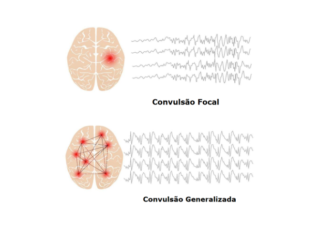 Desenhos comparativos de uma convulsão focal e uma convulsão generalizada e como são sentidas as atividades num exame.