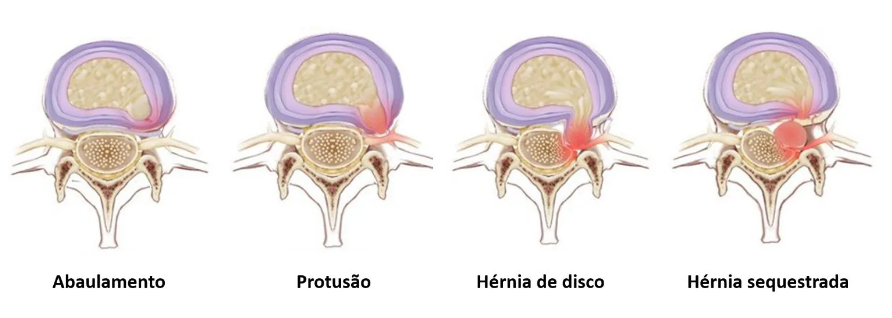 H Rnia De Disco Lombar Principais Sintomas Dr Thiago Rodrigues