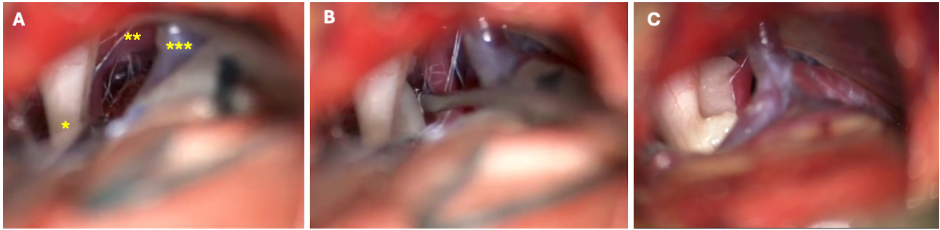 Descompressão microvascular do nervo trigêmeo mostrando compressão arterial e separação do vaso durante cirurgia para neuralgia do trigêmeo.