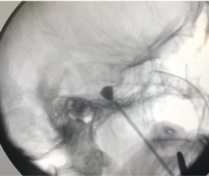 Compressão percutânea por balão do nervo trigêmeo guiada por fluoroscopia para tratamento da neuralgia do trigêmeo.